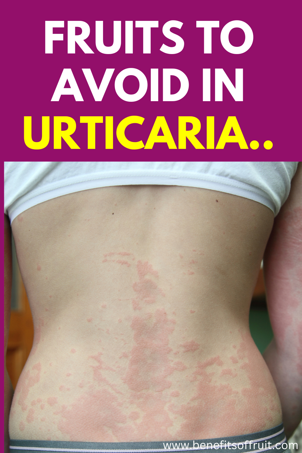 Fruits To Avoid During Urticaria