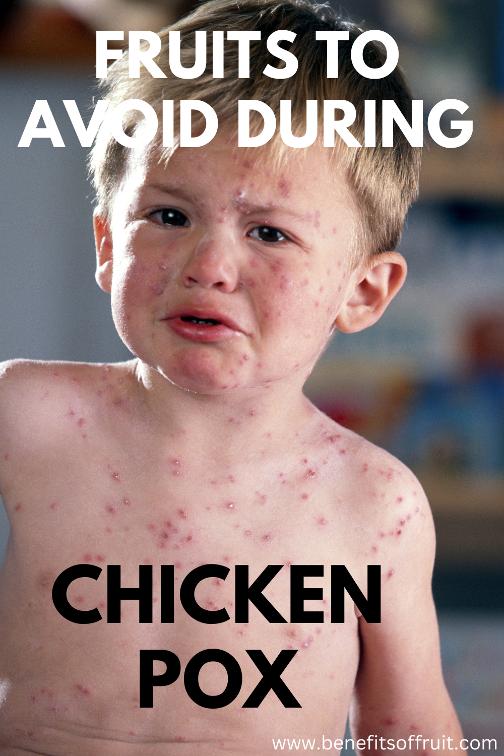 Fruits To Avoid During Chicken Pox