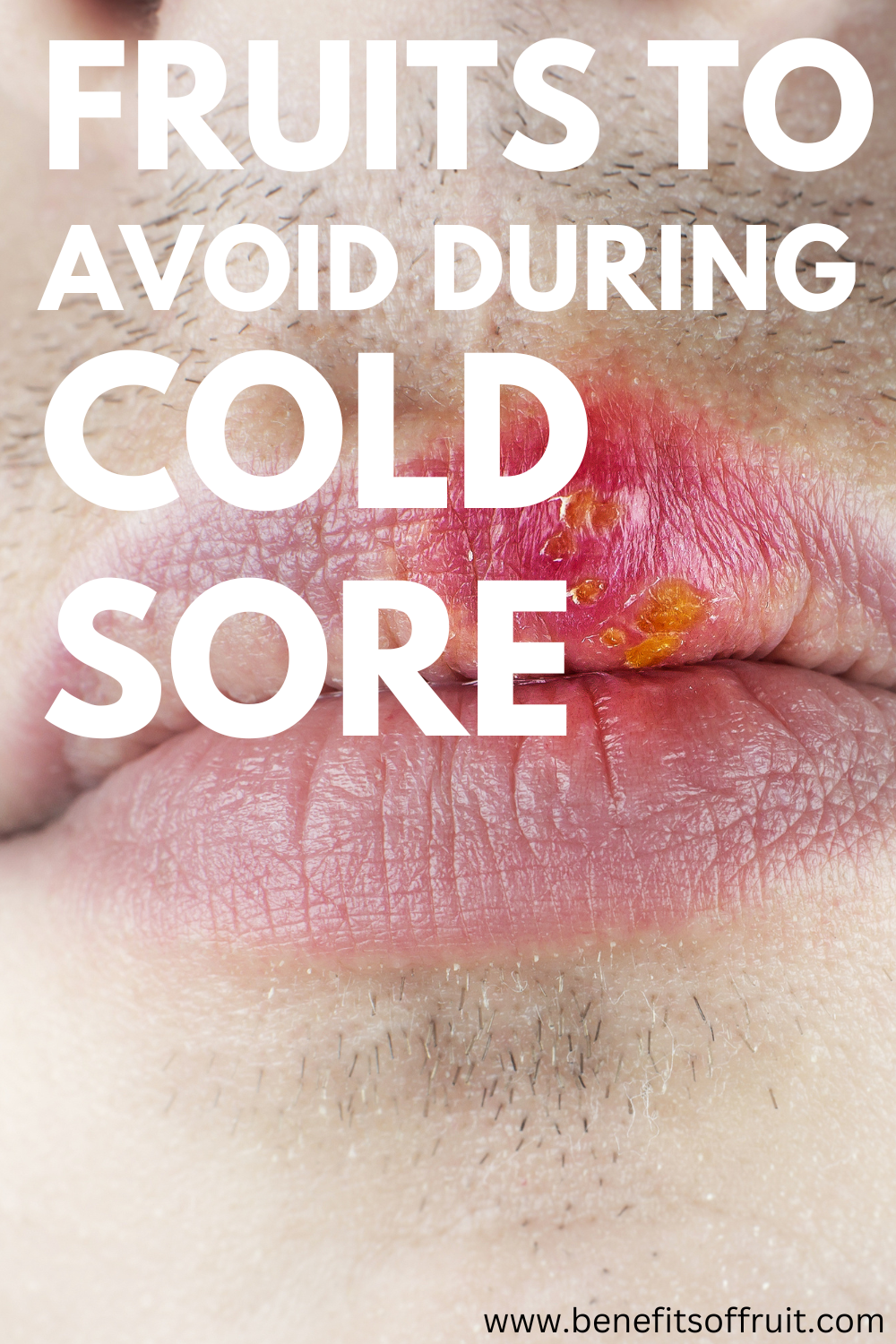 Fruits To Avoid During Cold Sore