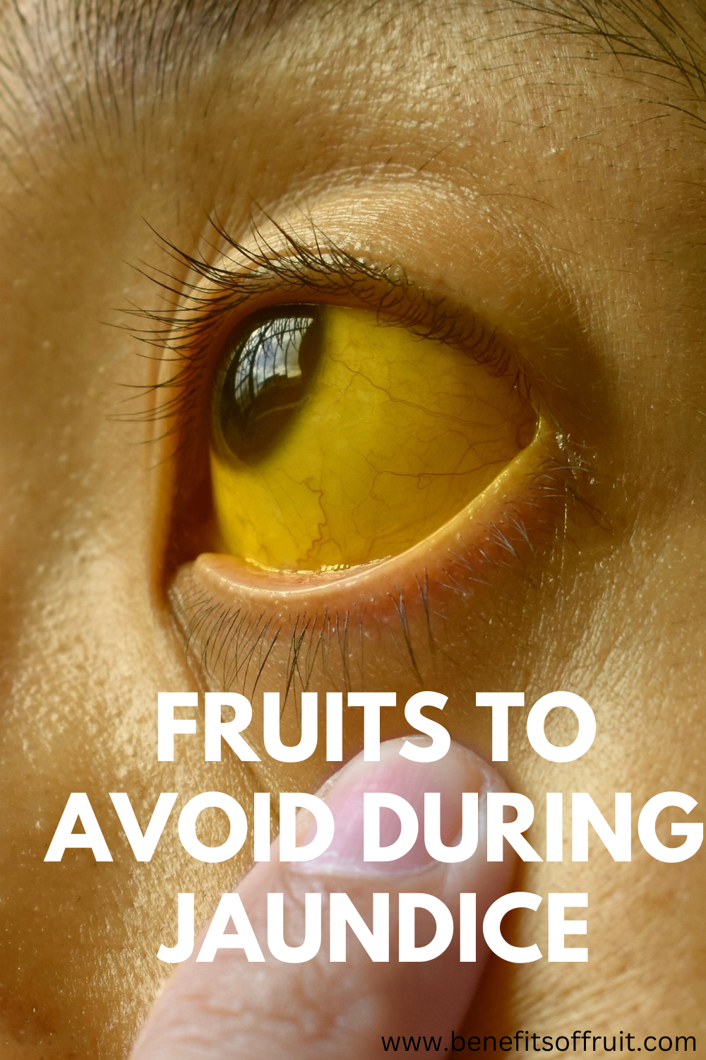 Fruits To Avoid During Jaundice